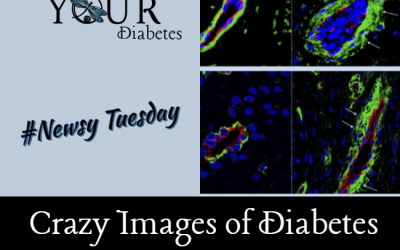 Newsy Tuesday: Crazy Images of Diabetes Blood Vessels!