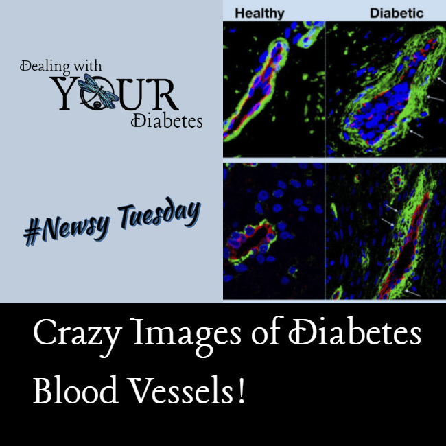 Crazy Images of Diabetes Blood Vessels